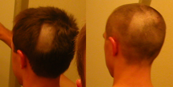 Two side-by-side photos of the back of my head: on the left, a thick bald stripe carved through the hair; on the right, the whole head buzzed short to even it out.